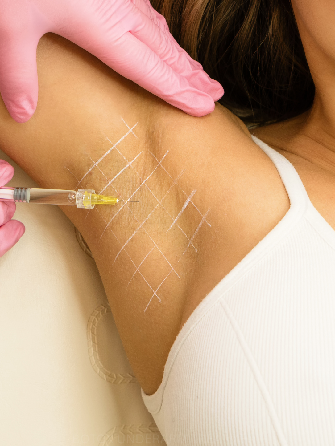 Close-up of underarm injection grid markings during hyperhidrosis treatment