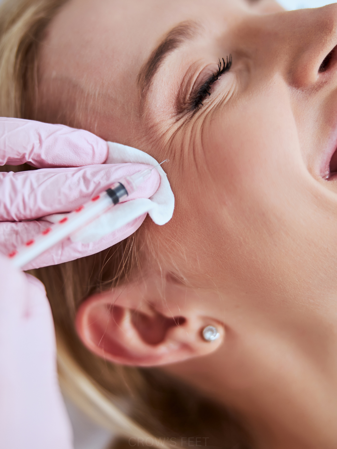 Crow's feet injection at side of eye