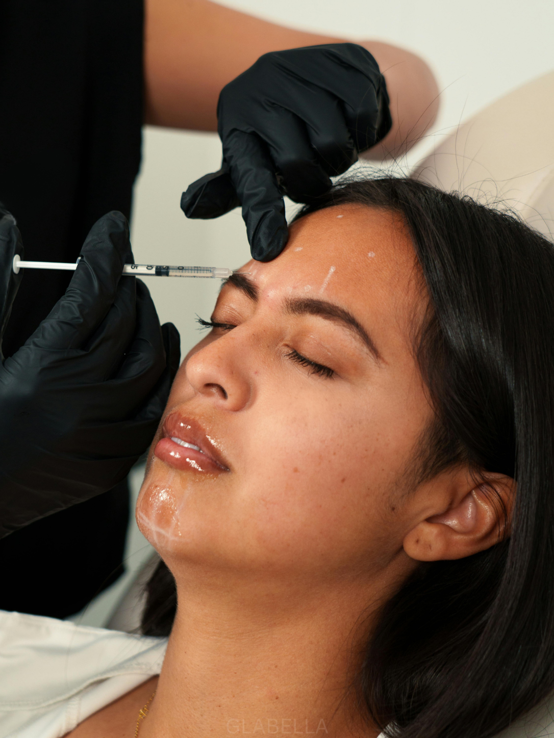 Glabella injection -- 11 lines treatment