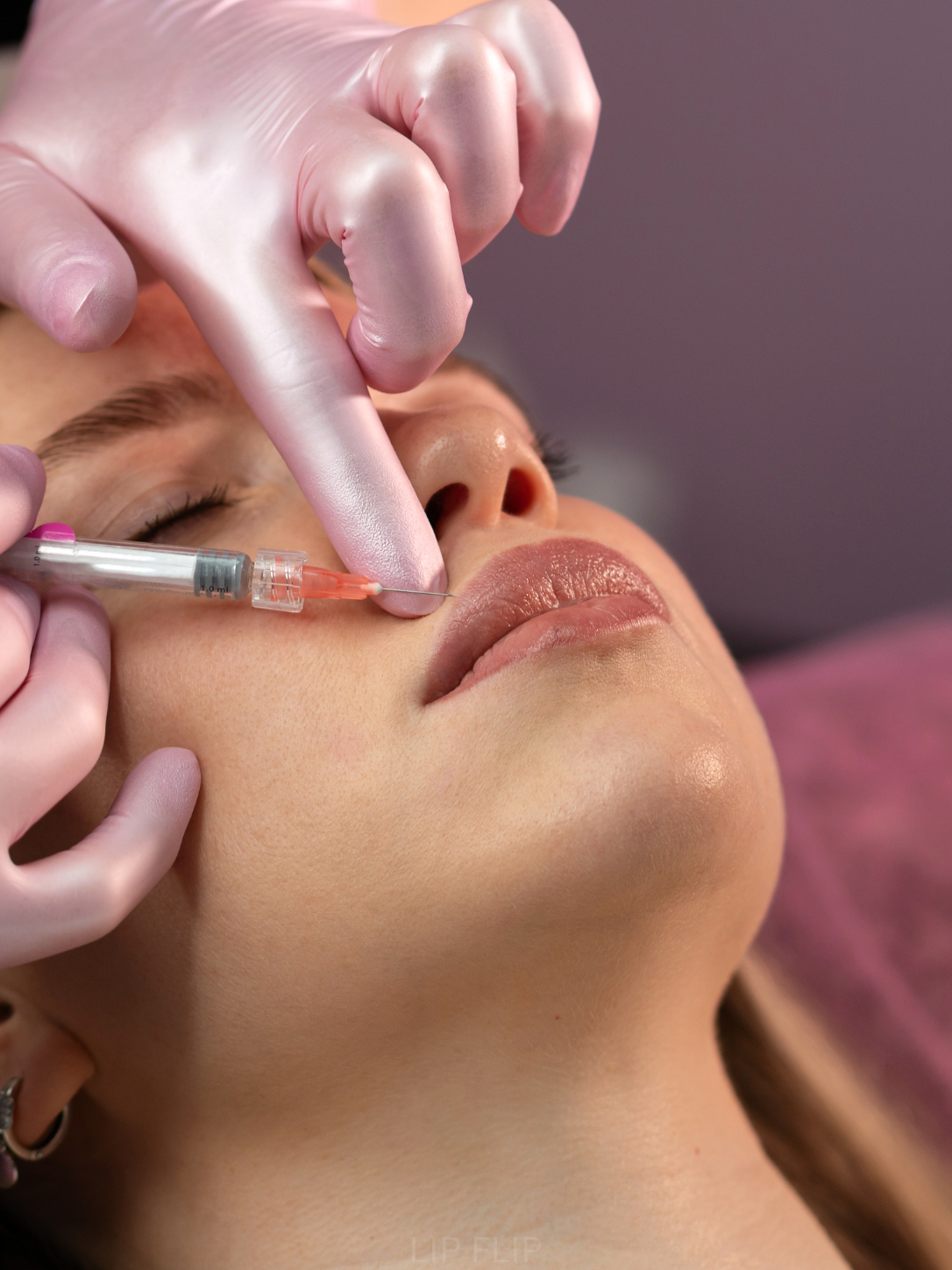 Lip flip neurotoxin injection for fuller upper lip appearance