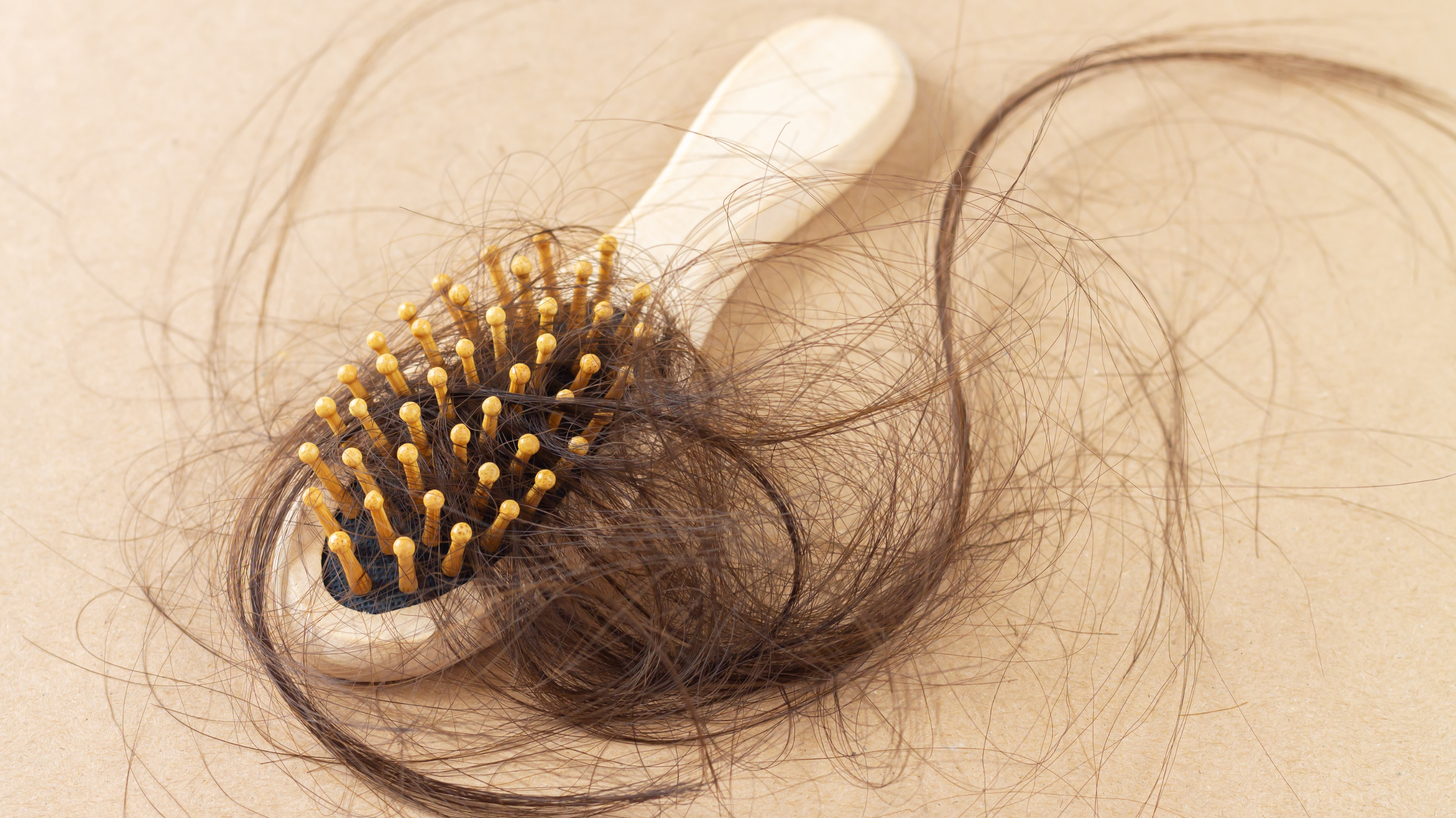 Hairbrush showing significant hair shedding and thinning from iron deficiency